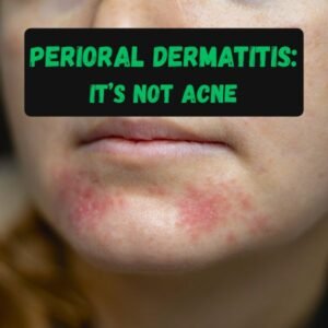 Perioral Dermatitis