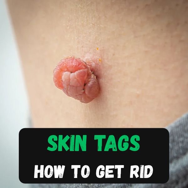 Skin Tags in Armpit